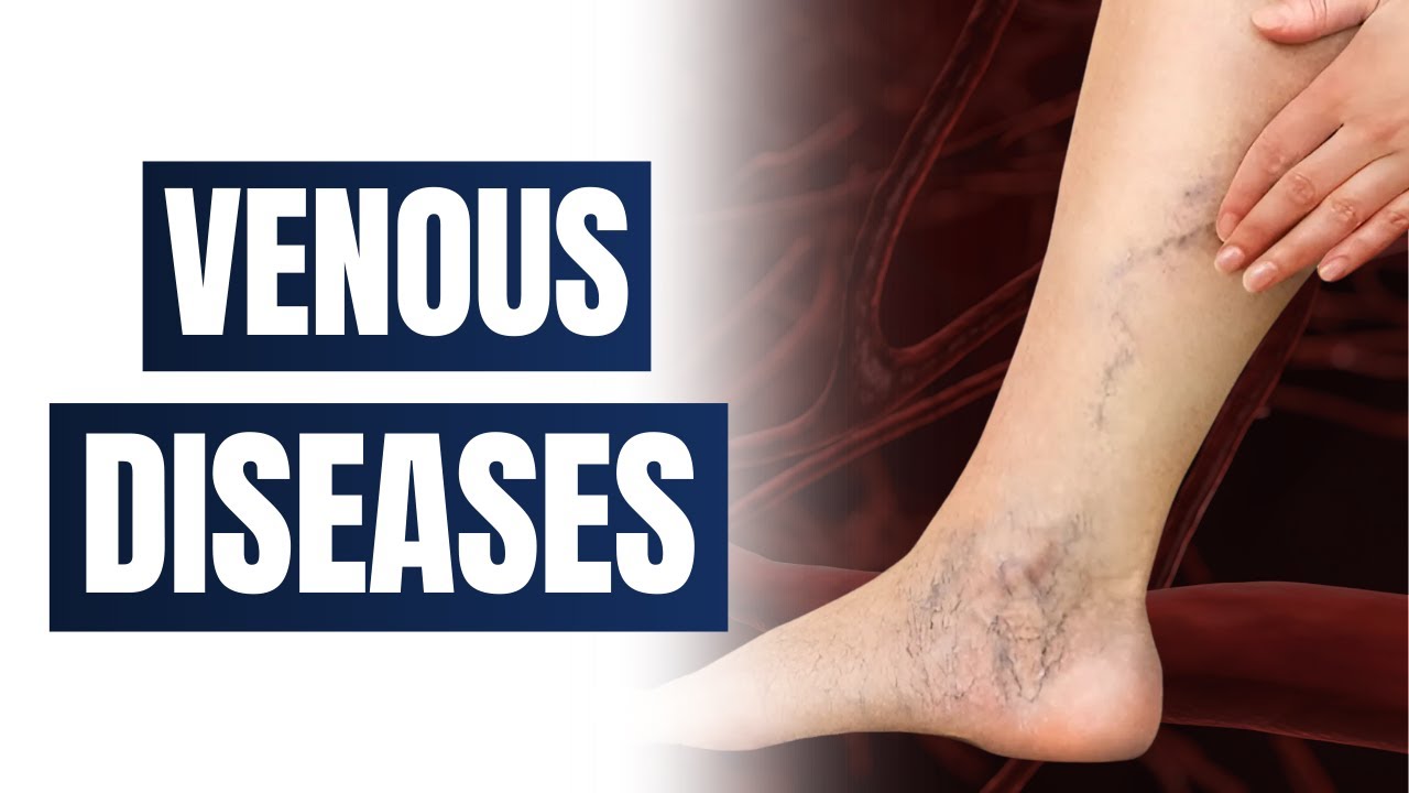 Understanding Venous Problems: Varicose Veins, DVT, and More