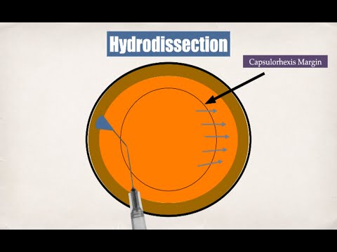 Learning from a Learner part 3 - Hydro procedures and Nucleus prolapse in MSICS : Dr. Nikunj Tank