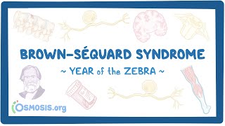 BrownSéquard syndrome (Year of the Zebra)