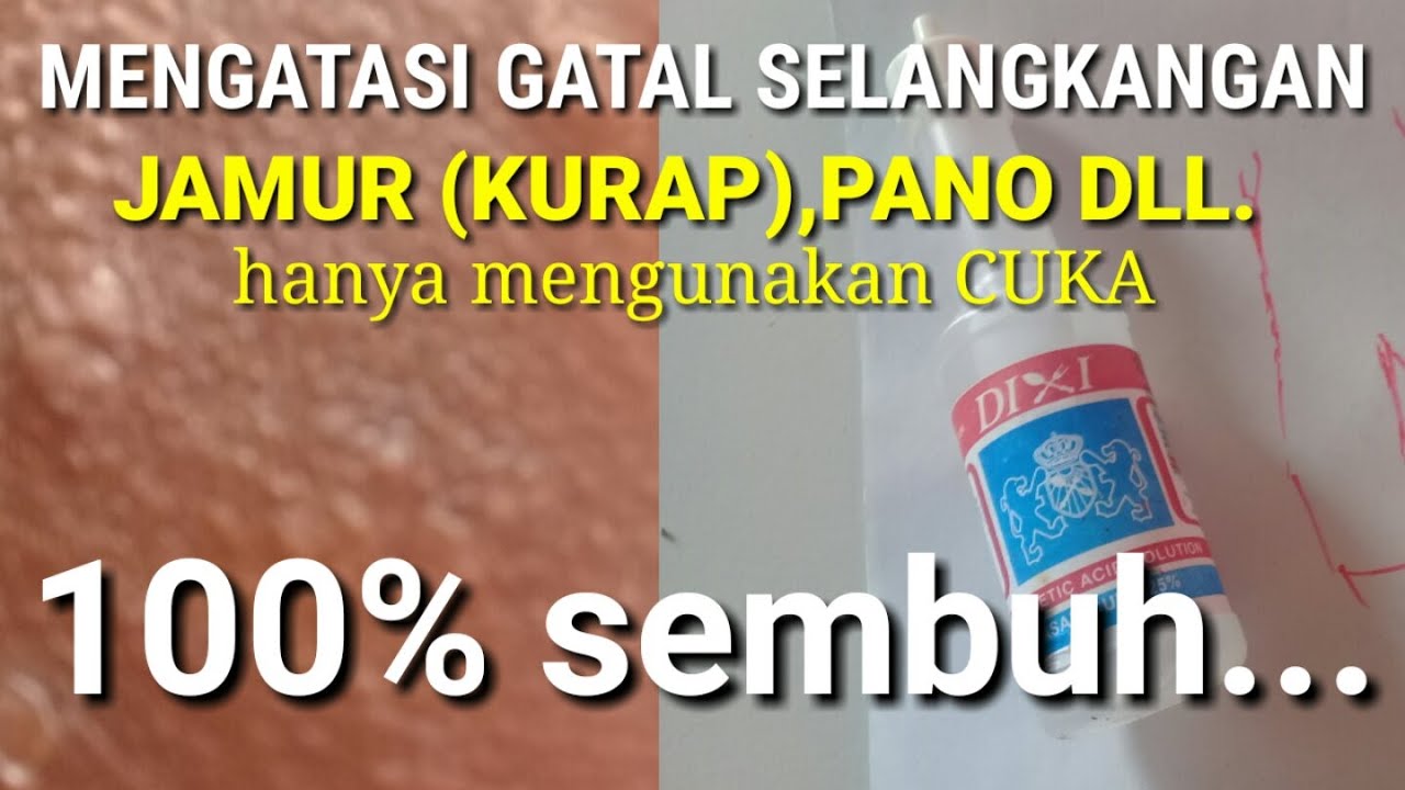 #mengobatigatalgatal #jamur MENGOBATI|MENGATASI GATAL SELANGKANGAN