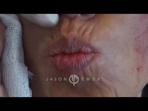GET BOTOX FOR FINE MOVEMENT LINES & WRINKLES AROUND THE MOUTH| PERIORAL REJUVENATION |Dr. JASON EMER