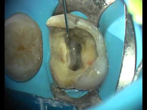 Endodoncia Primer Molar Superior (Conductos Curvos)