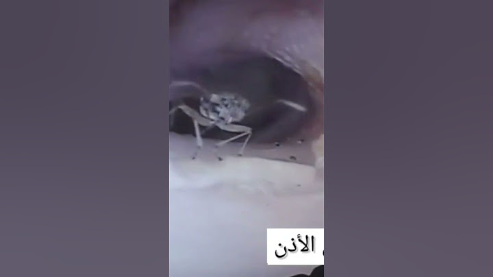 ازالة حشرة من داخل الأذن