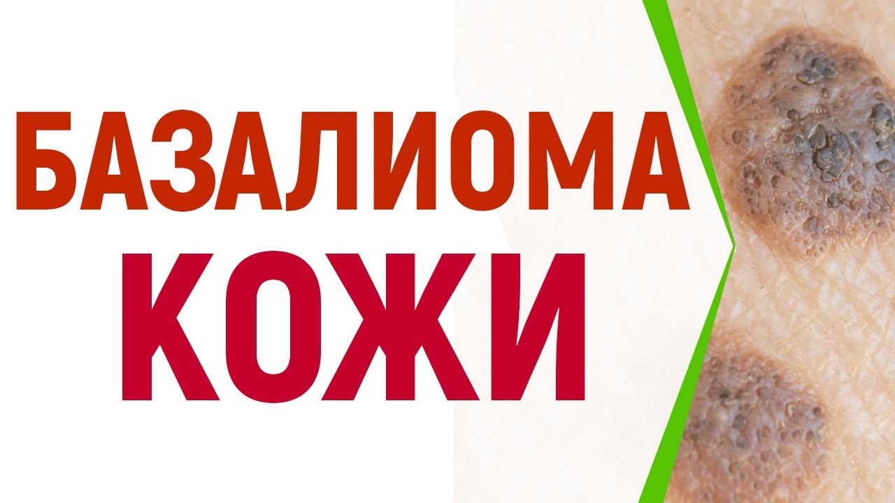 Базалиома кожи - YouTube