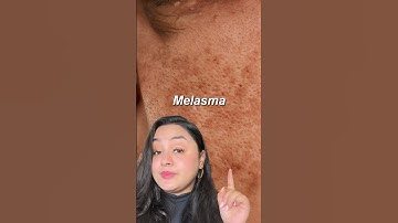 Skincare products for Melasma that Worls✨ #facedecor