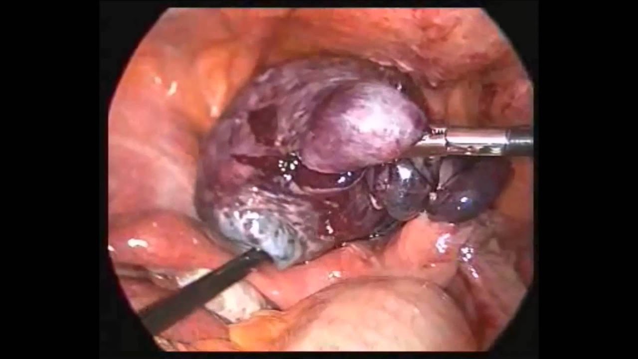 Laparoscopic surgery, best treatment for torsion of ovary cyst: Dr