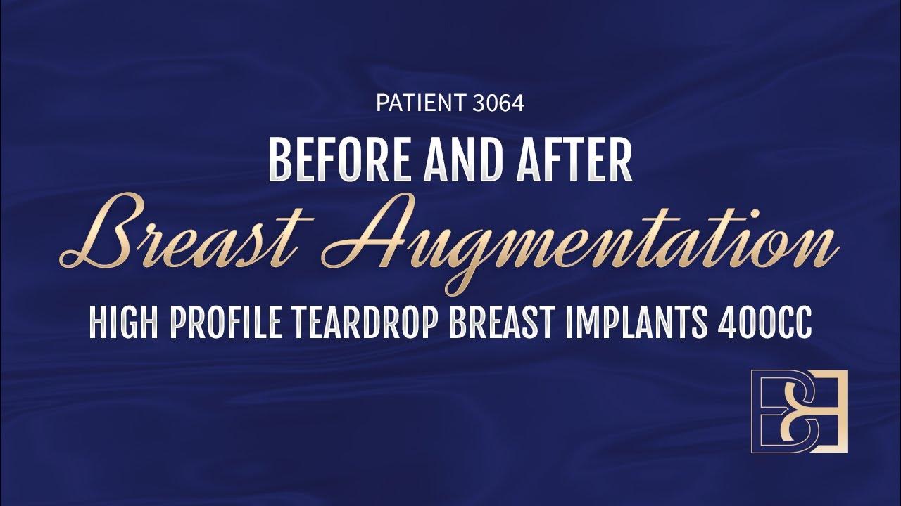 400cc Breast Implants Patient 3064 Augmentation Mammaplasty Before 400cc-breast-implants-patient-3064-augmentation-mammaplasty-before