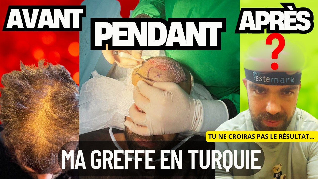 Greffe de Cheveux en Turquie : Résultat CHOC, J'ai TOUT filmé chez Estemark