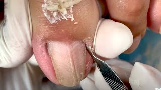 How to Repair Nails easy #393 - Xuyen Nail