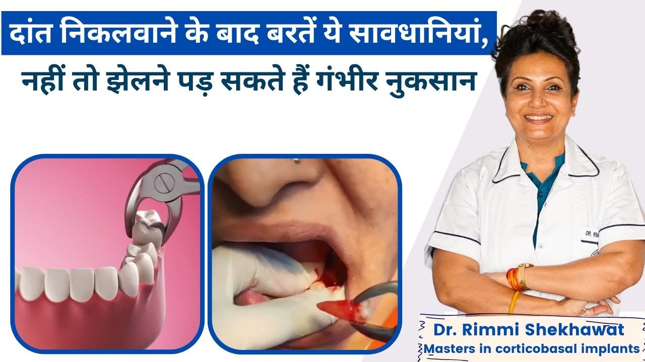 दांत निकालने के बाद किन-किन बातों का ख्याल रखना चाहिए? दांत निकालने के बाद क्या खाएं और क्या न खाएं?