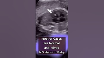 Fetal Cardiac Echogenic Focus | Ultrasound