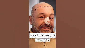 عمليه شد الوجه وتجميل الانف النتيجة قبل وبعد صدمة 