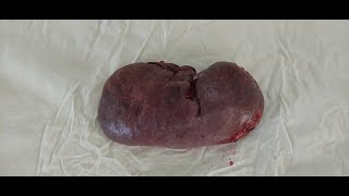 Увеличение селезенки при портальной гипертензии. Макропрепарат.