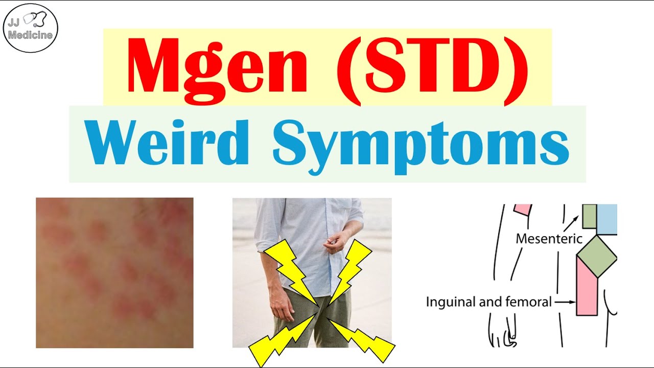 ЗППП, о котором вы никогда не слышали: странные симптомы Mgen (врачи их пропускают)