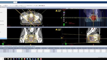 Varian Eclipse 3 Field (Mercedes) Technique