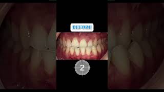 Invisalign Smile Transformation: 11-Week Progress. Patient had an underbite.