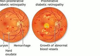 Ophthalmology    2 , DIABETIC RETINOPATHY , Proliferative