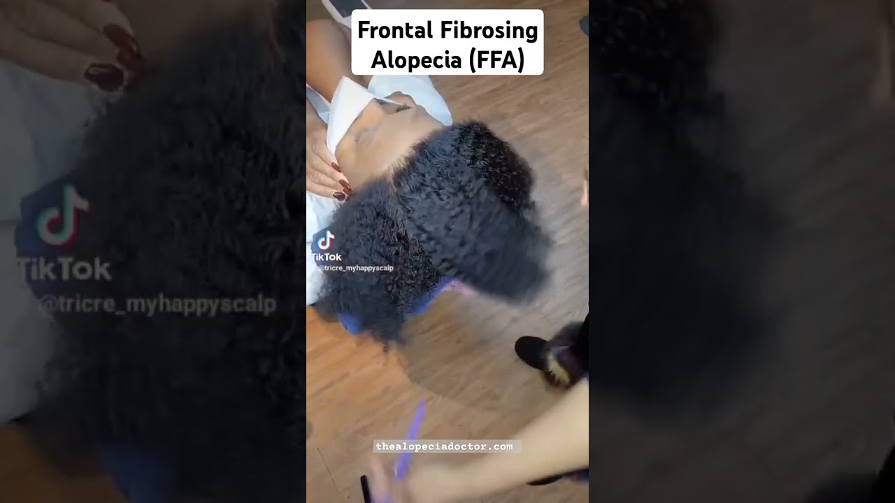 Пересадка волос при фронтальной фиброзной алопеции от специалиста по выпадению волос из Хьюстона....