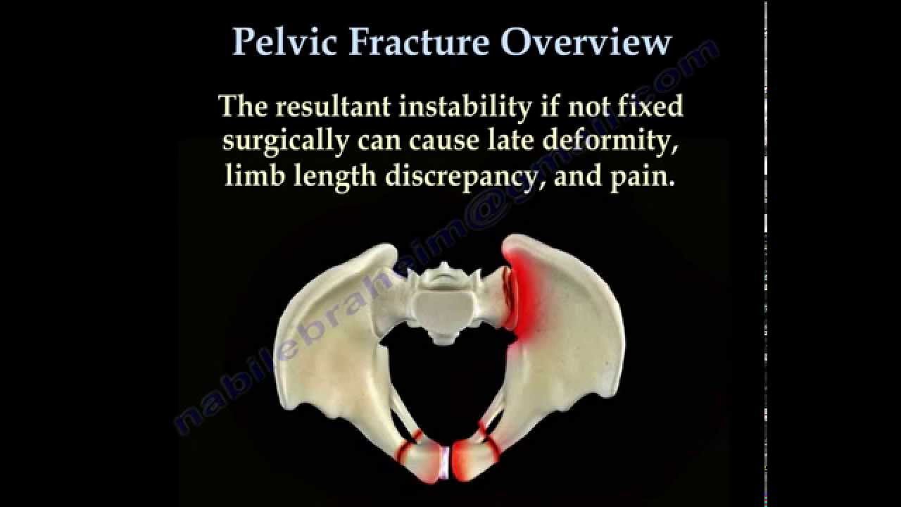 Pelvic Fracture (orthopedics) - YouTube