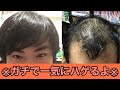 「最近おでこ/生え際が気になる…」早めにケアしないと僕みたいになりますよ