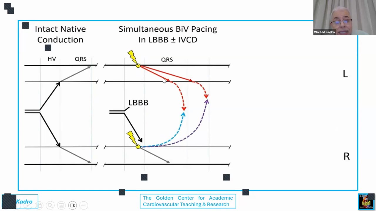 العلاج المتقدم بإعادة التزامن واستخدام زرع ناظم الخطا على الأجهزة الناقلة.
