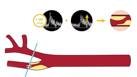 Identifying carotid artery disease with ultrasound