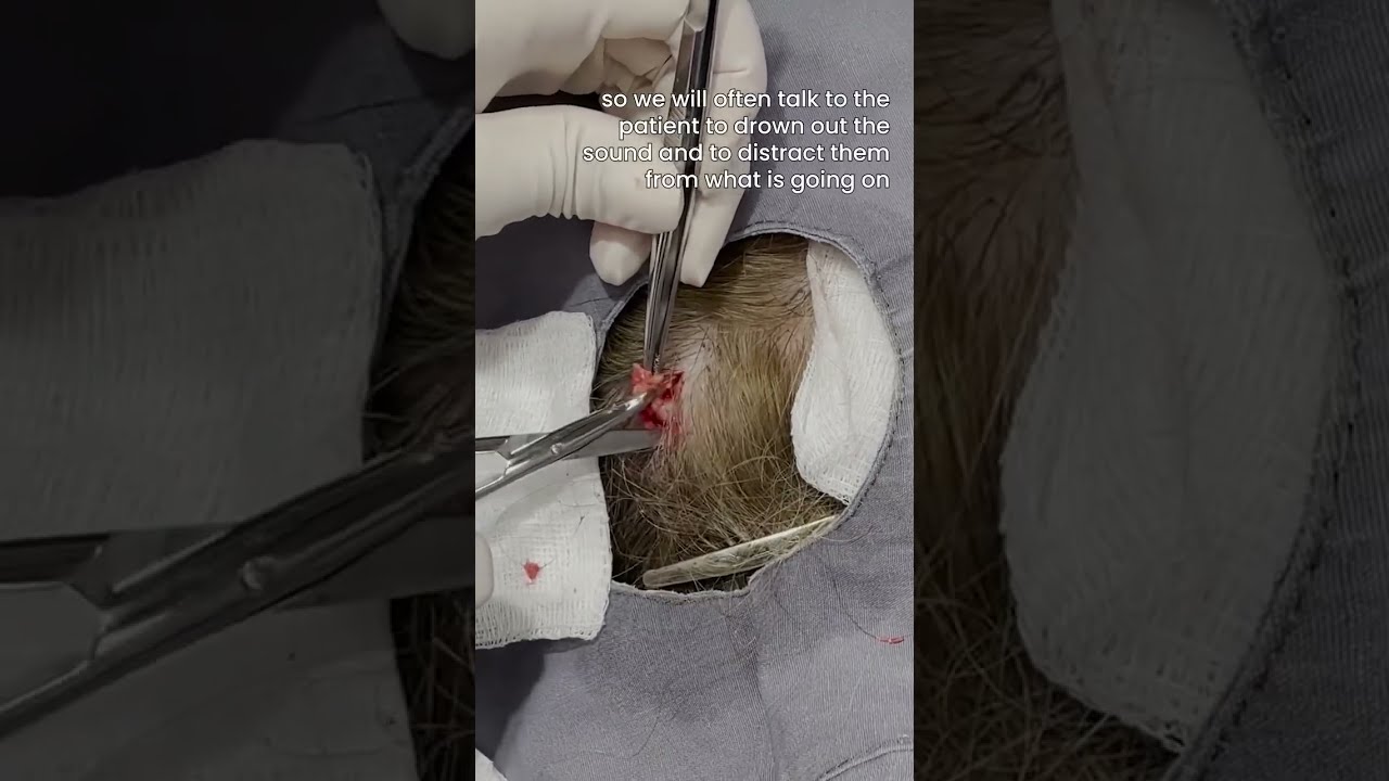 Here S The First Of 2 Pilar Cysts That You Couldn T Really See But They Were There 