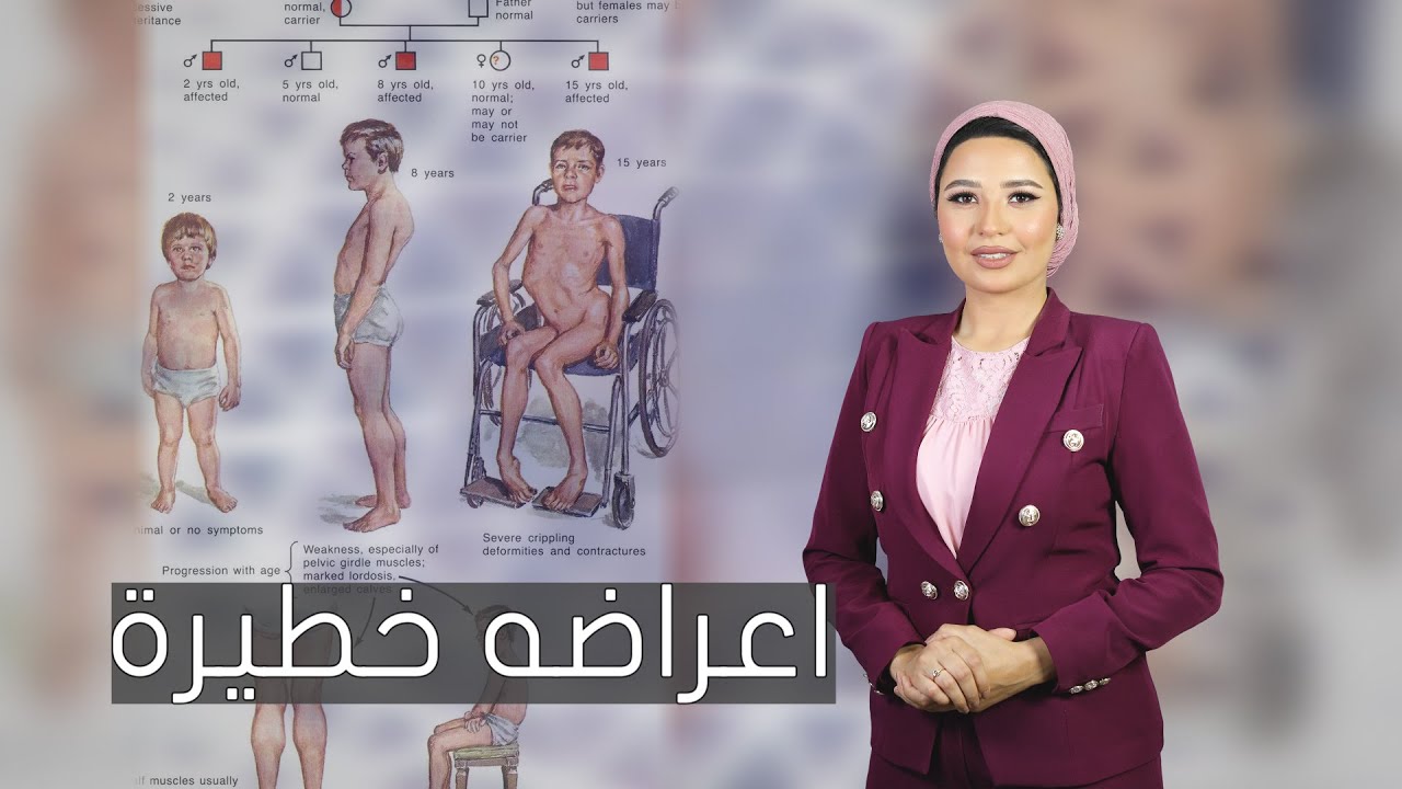 سعر الحقنة ٣ مليون دولار .. اسباب غير متوقعة وراء الإصابة بالضمور العضلي