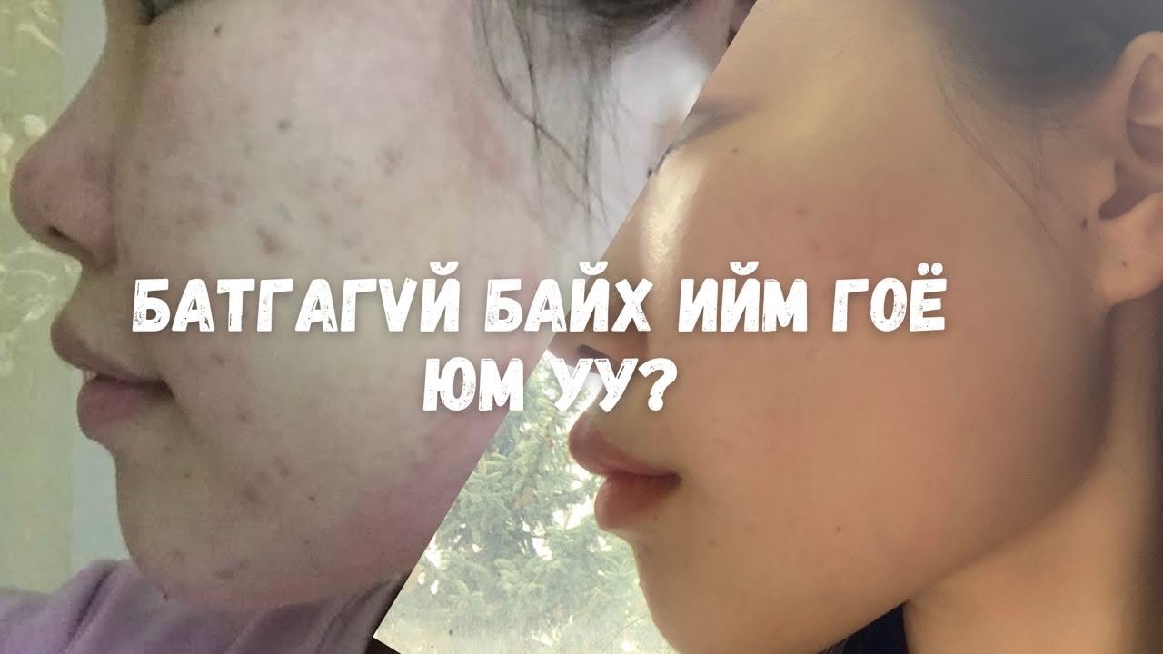 Би Хэрхэн Үрэвсэлтэй Батганаасаа Салсан Бэ?|