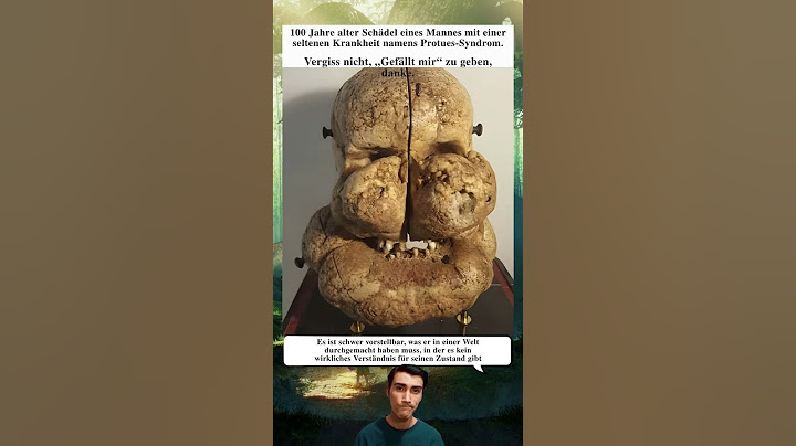 😱 100 Jahre alter Schädel mit seltener Proteus-Syndrom-Krankheit entdeckt ❤️