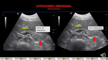 ¿Puede la ecografía detectar la pancreatitis crónica?