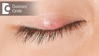 How is a Stye treated? - Dr. Sunita Rana Agarwal