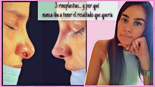 Mis rinoplastias y por qué nunca &quot;serán suficiente&quot; ǀ Karla Empodera