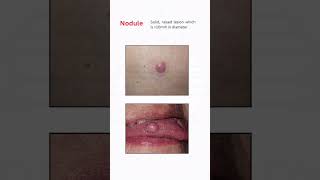 How To Differentiate Between Common Skin Lesions