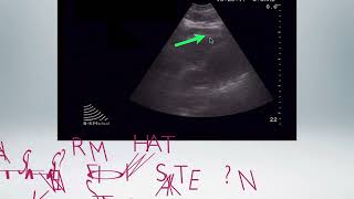 How to perform Ultrasound for Pericardial Effusions and Tamponade.