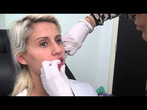 Video: Varför Hyaluronsyra Förstorar Läpparna
