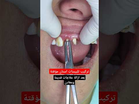 تلبيسات اسنان مؤقتة