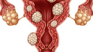ما هي الأورام الليفية وطرق الوقاية والعلاج ؟