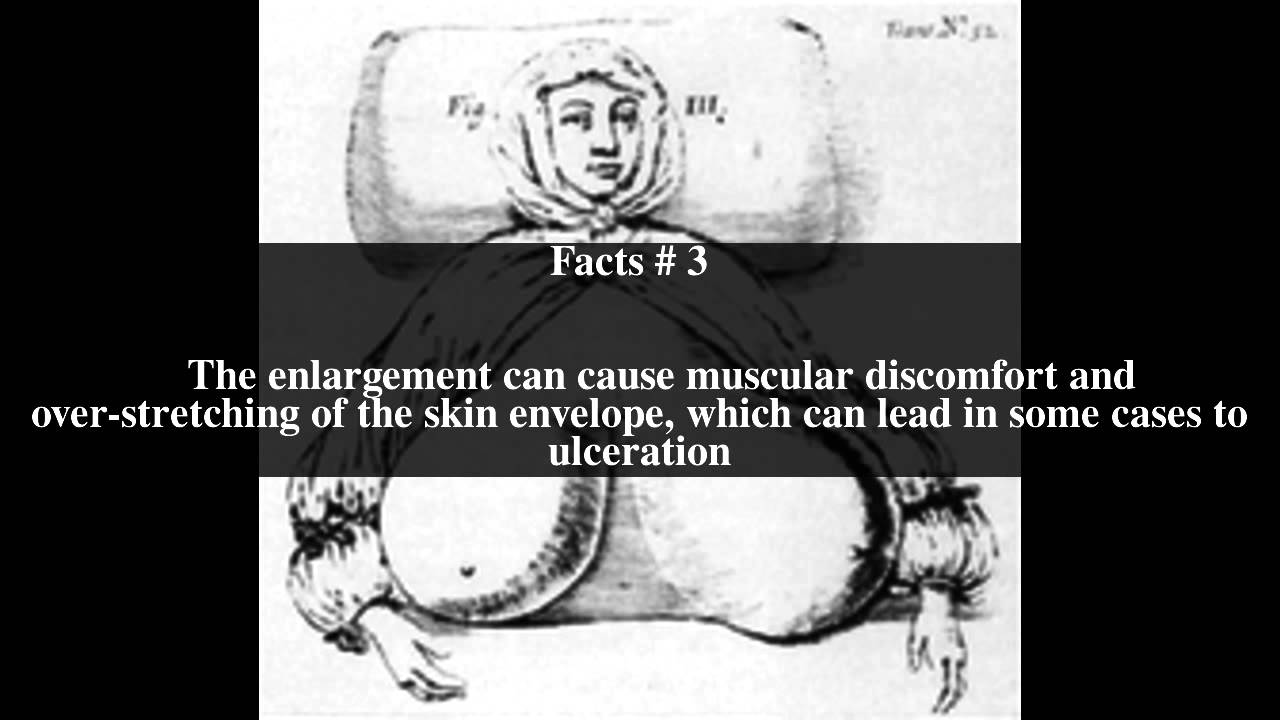 Hypertrophy of breast Top 5 Facts YouTube