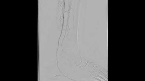 Use of retrograde access for BTK angioplasty