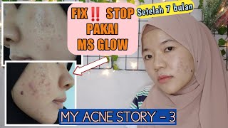 ALASAN BERHENTI PAKAI MS GLOW | My Acne Story 3
