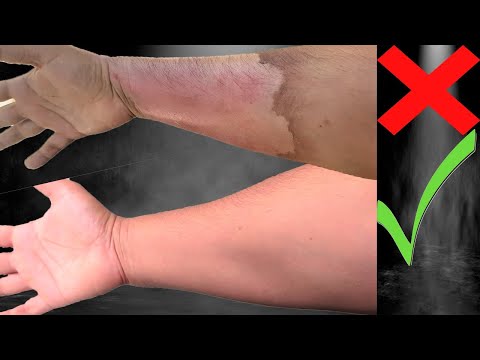 Video: Cómo evitar que una quemadura deje cicatrices: 13 pasos (con imágenes)