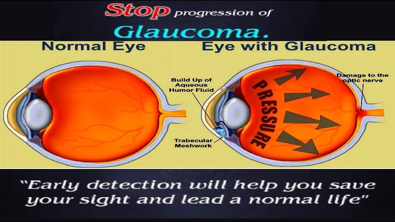 Глаукома латынь. Глаукома на английском. Glaucoma Awareness month.