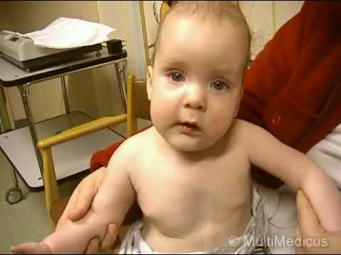 Video: Kuinka Siirtää Lapsi Hypoallergeenisesta Seoksesta