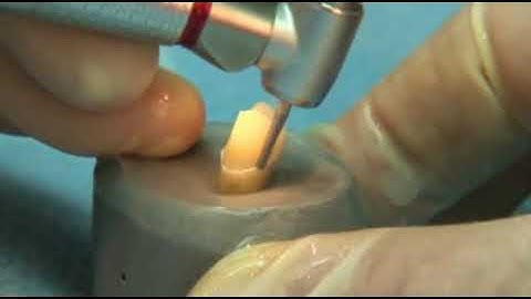 Mài cùi răng sử dụng mũi khoan SSwhite