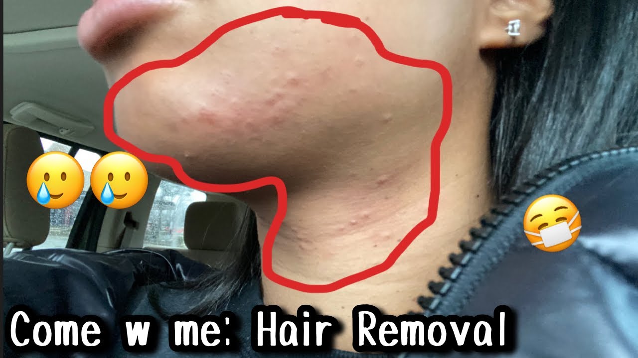 Hair removal satisfying electrolysis ingrown hairs YouTube