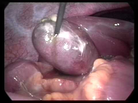 Laparoscopic Videos (edited-10)- Lap Chole In Pregnancy-14 & 36 Weeks