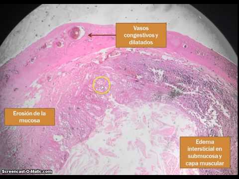 Video: Qual è il significato di fibrinopurulento?