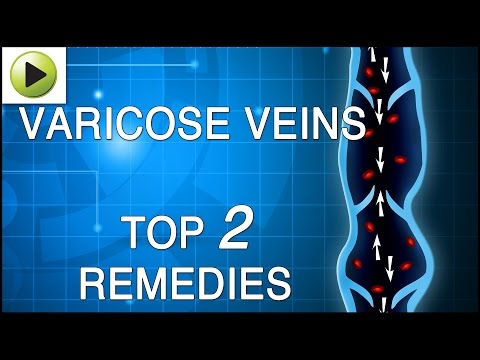 varicose-veins---natural-ayurvedic-home-remedies
