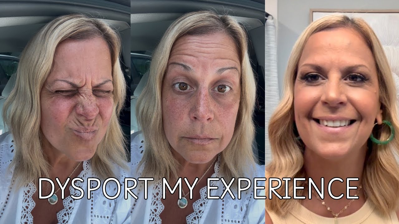 DYSPORT / BOTOX /  1 WEEK RESULTS / FIRST TIME / OVER 55 